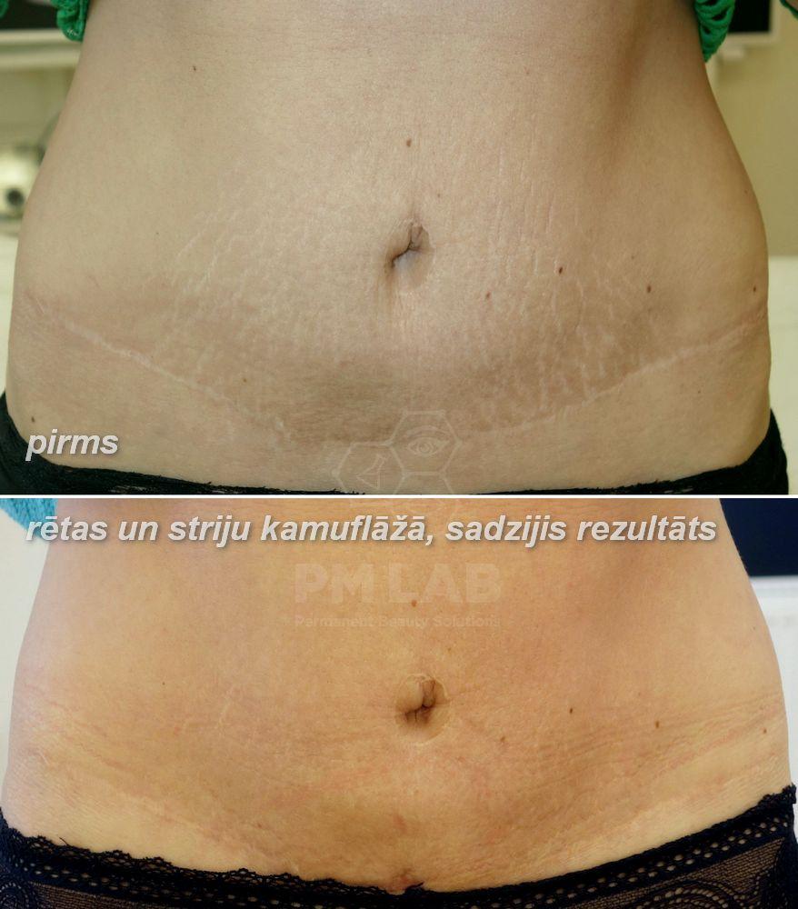 Micropigmentation is the stretch marks correction way. 