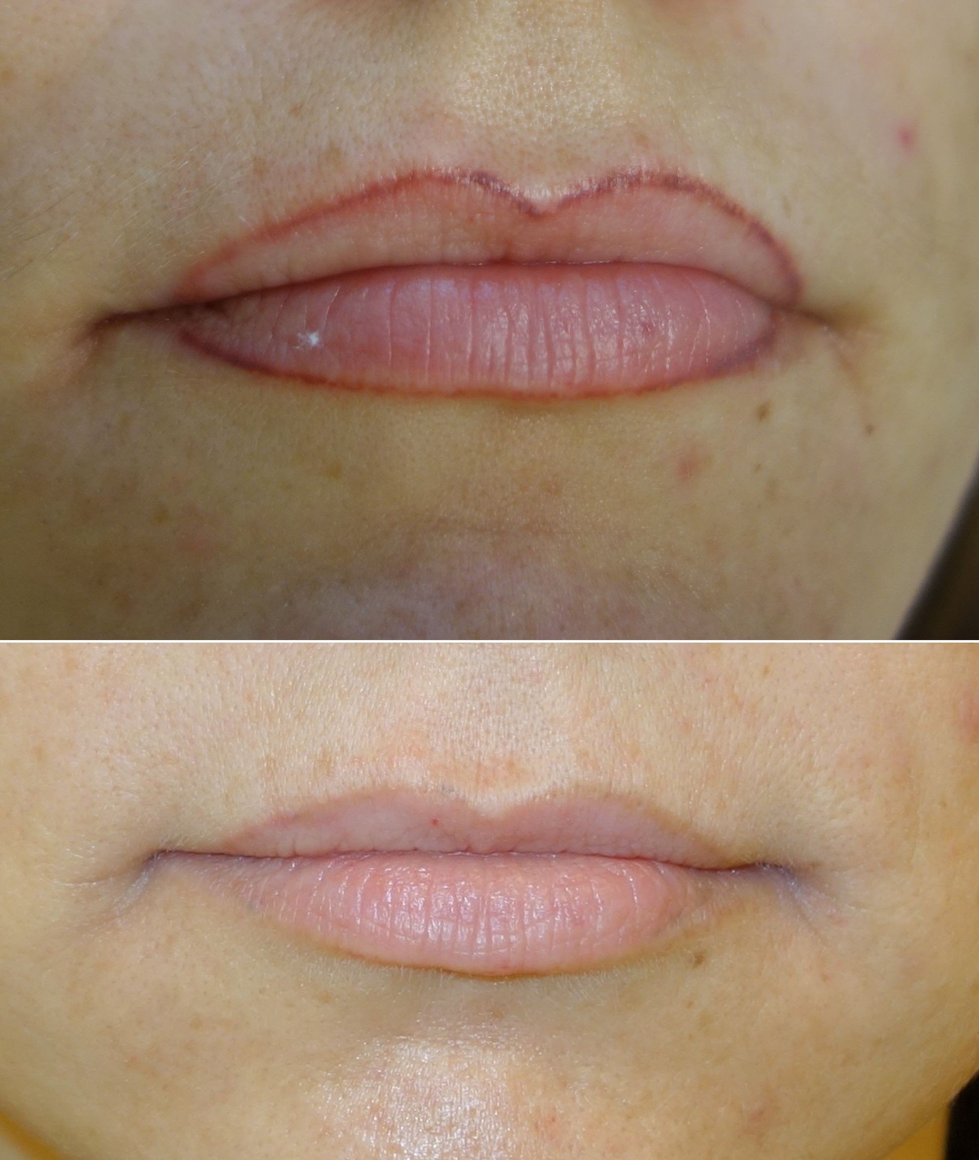 Laser removal as the main approach of defective permanent make up and tattoo correction. 
