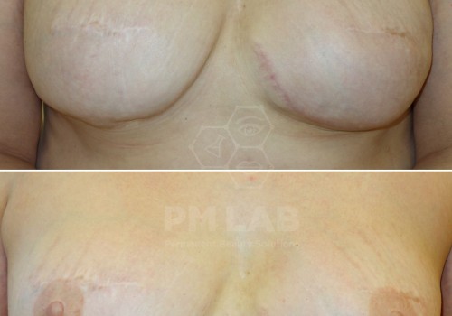 PM LAB helps women who survive breast cancer to regain femininity.
