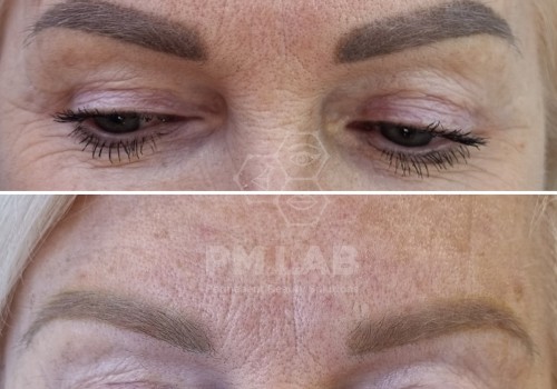 Pigment removal with laser
