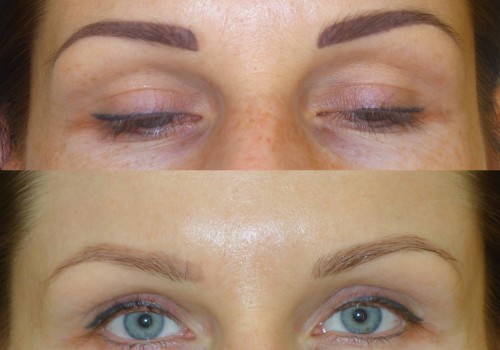 Pigment removal with laser