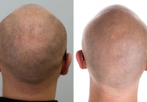 Tricopigmentation (hair imitation pigmentation)